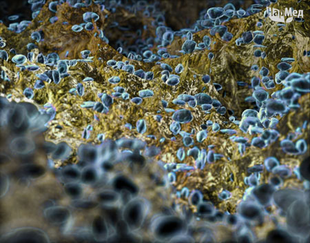 Бактерии туляремии (Bacterium tularensis) частый возбудитель ангины